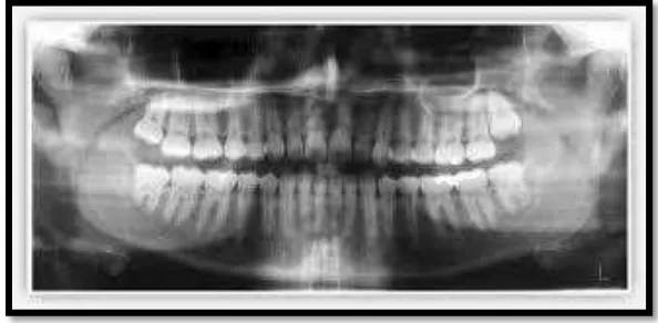 Gambar 7. Gambaran radiografi kerusakan tulang alveolar17 