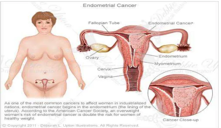 Gambar 2.1. Kanker endometrium 