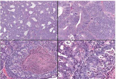 Gambar 2.2 Adenokarsinoma endometrium 