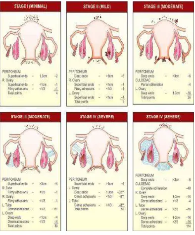 Gambar 2 . Klasifikasi Endometriosis .12 