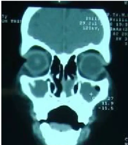 Gambar 3 Tomografi komputer sinus paranasal (potongan  coronal) 