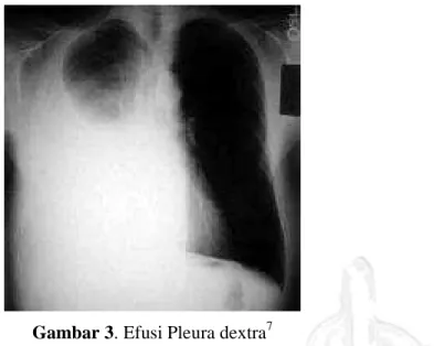 Gambar 3. Efusi Pleura dextra 7 