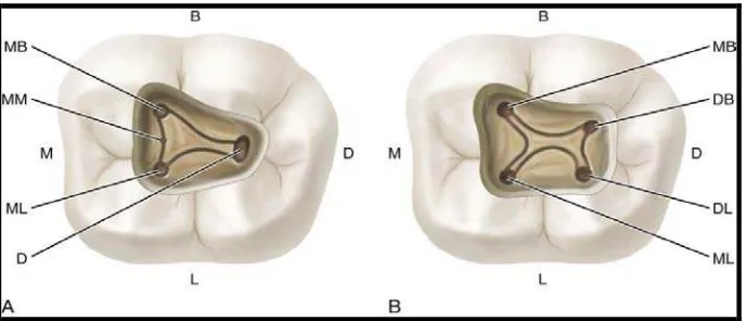 Gambar 10. Variasi jumlah orifisi  molar satu  mandibula  permanen                     (B=bukal,     L = Lingual, M = Mesial, D = Distal,  MB =                     Mesiobukal,  MM = Middle Mesial, ML=Mesiolingual).18  