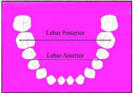 Gambar 3. Metode pengukuran lebar lengkung gigi  rahang bawah menurut rakosi, dkk 18  