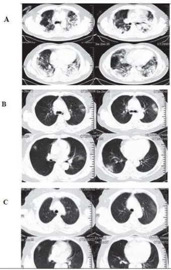 Gambar 2.2 Gambaran CT Scan Toraks pasien pneumonia COVID-19 di Wuhan,  Tiongkok (Huang et al, 2020)