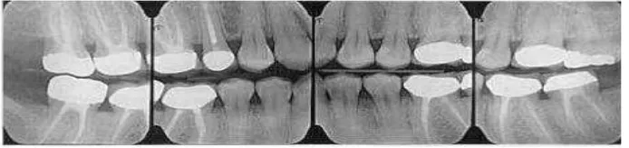 Gambar 1. Gambaran radiografi interproksimal/bitewing.8 