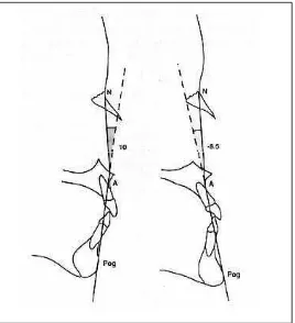 Gambar 10. Konveksitas skeletal menurut Downs. Diperoleh      dari  sudut yang dibentuk oleh garis N-A ke garis     A-Pog.11,29 