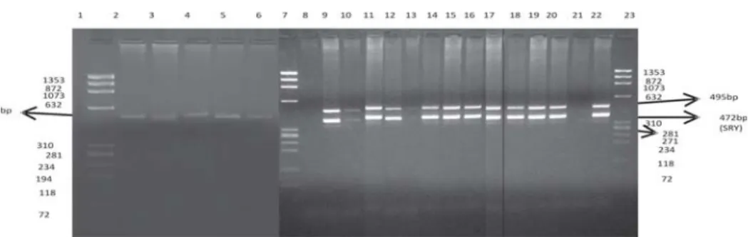 Gambar 2. Gel Agarose hasil pemeriksaan gen SRY di Laboratorium DNA KK Hospital. Pada pemeriksaan ini tampak adanya 2 buah pita band, pita band yang pertama menunjukkan kontrol internal (gen ZFY) mempunyai besar produk 495 bp, pita band yang kedua menunjuk