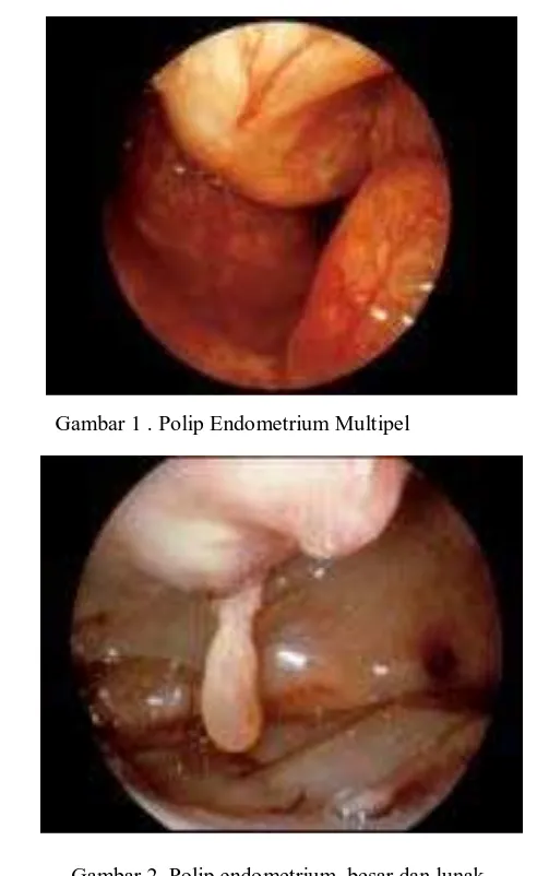 Gambar 2. Polip endometrium  besar dan lunak. 