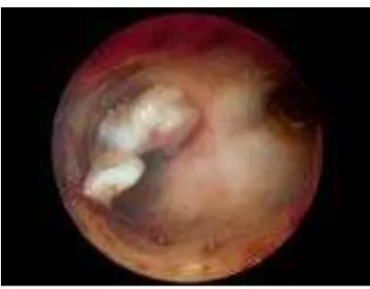 Gambar 3. Polip endometrium yang terletak pada dinding inferior uterus