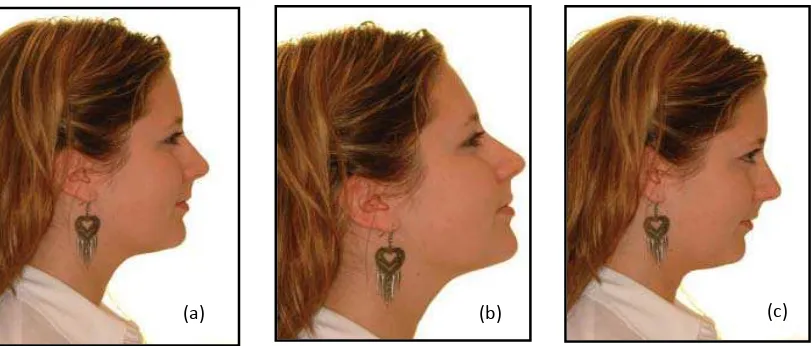 Gambar 6.  Foto lateral wajah. (a) Posisi ideal, (b) Posisi tidak benar, menginformasikan maloklusi klas III, (c) Posisi tidak benar, menginformasikan maloklusi klas II10  