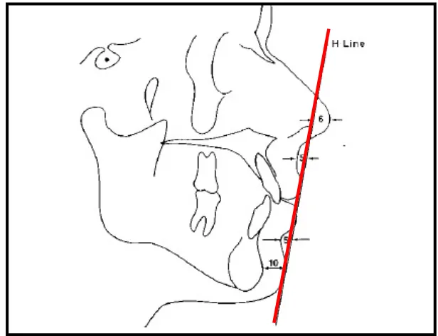 Gambar 8. Jarak puncak hidung ke garis H, kedalaman sulkus labialis superior,jarak bibir bawah ke garis H, kedalaman sulkus labialis inferior, dan tebal dagu10 
