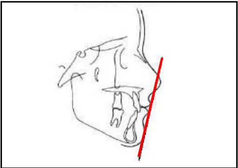 Gambar 5. Analisis jaringan lunak wajah menurut Steiner (S line)20 