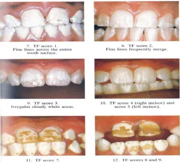 Gambar 2.2 Indeks Pengukuran Dental Fluorosis berdasarkan Indeks 
