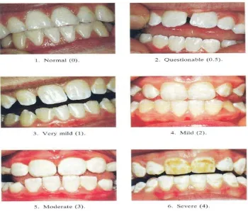 Gambar 2.1 Indeks Pengukuran Dental Fluorosis berdasarkan Indeks Dean 