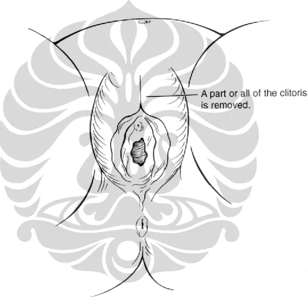 Gambar 1: Anatomi Alat kelamin Perempuan yang Telah Menjalani Sirkumsisi 58