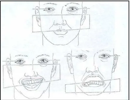 Gambar 3. Proporsi wajah tidak seimbang. Asimetris karena pergerakan vertikal15 
