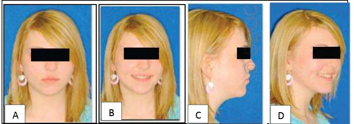 Gambar 4. Fotometri Ekstra oral. (A) Foto frontal dengan bibir relaks, (B) Foto frontal dengan bibir dalam keadaan tersenyum, (C) Foto lateral dengan bibir relaks, (D) Foto profil 45o dengan bibir dalam keadaan tersenyum16 