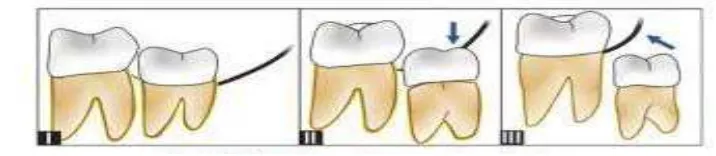 Gambar 2. Klasifikasi molar tiga impaksi kelas I,II,III menurut 