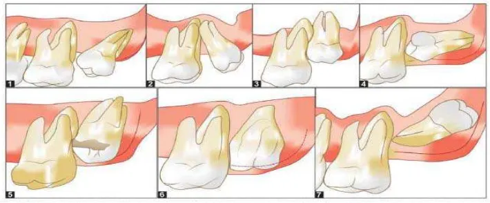 Gambar 3. Klasifikasi molar tiga impaksi posisi A,B,C menurut  Pell dan 