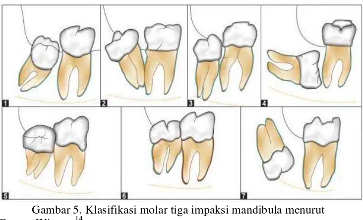Gambar 5. Klasifikasi molar tiga impaksi mandibula menurut 