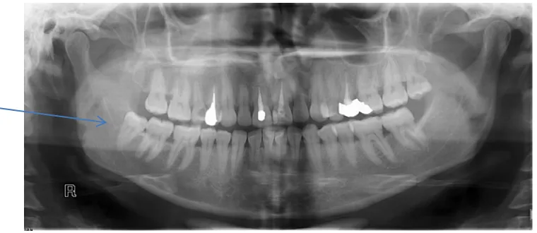 Gambar 7. Molar tiga impaksi mandibula kiri kelas II-C Kelas II: Ruangan yang tersedia untuk erupsi molar tiga        antara batas anterior ascending ramus dengan distal gigi                                            molar dua kurang dari mesiodistal mola