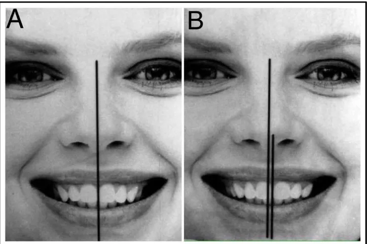 Gambar 8. Penilaian  Fotometri  A.  Midline  wajah dan midline dental berimpit pada satu garis lurus B