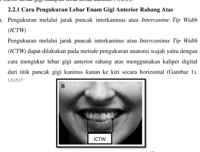 Gambar 1. Intercanine tip width (ICTW )17 