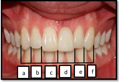 Gambar 3. Width of Distal Canine (WDC) 33 