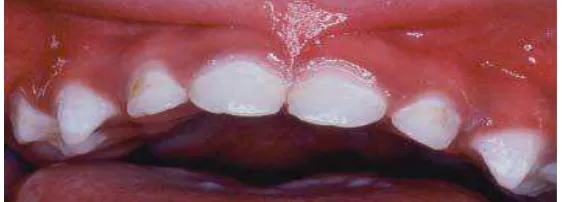 Gambar 2.  Kavitas berwarna kuning kecoklatan pada bagian      lingual gigi8 