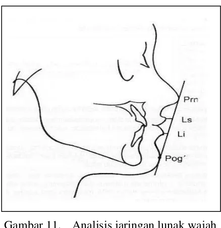 Gambar 11. Analisis jaringan lunak wajah  menurut Ricketts (garis E)27 