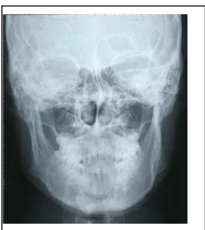 Gambar 2. Alat radiografi sefalometri22,23 