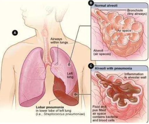 Gambar 2. Paru dengan Pneumonia 