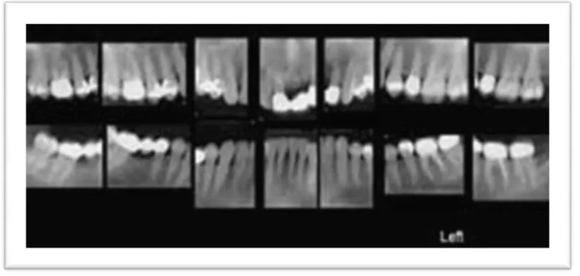 Gambar 1. Hasil radiografi periapikal 10