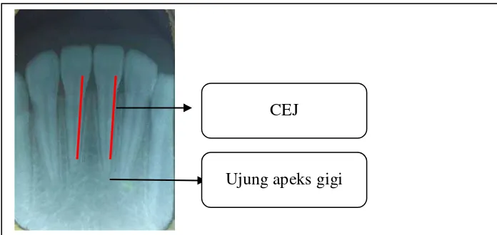 Gambar 7. Cara pengukuran panjang akar insisivus sentralis mandibula 