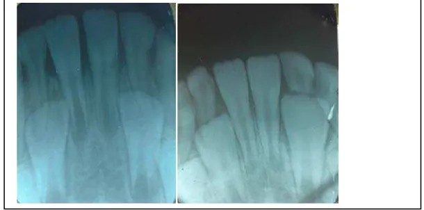 Tabel 4. Persentase rata-rata panjang akar insisivus sentralis mandibula pada usia 7 