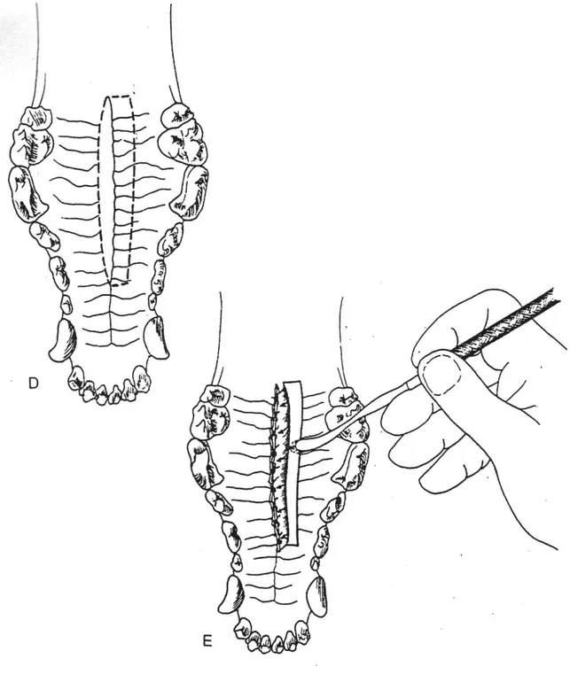 Gambar   10.  Rekonstruksi  celah  pada  palatum  durum  dengan  penutup  bilateral.              A