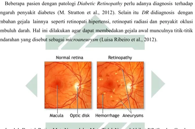 Gambar 1.1. Bentuk Retina Mata Normal dan Mata Tidak Normal Akibat DR (Sumber Gambar: 