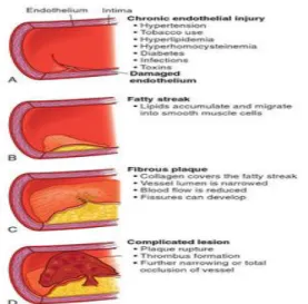 Gambar 2.2 Tahap perkembangan aterosklerosis (Bucher dan Johnson, 2013)