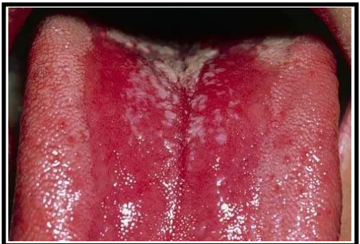 Gambar 7. Oral thrush yang disebabkan oleh jamur 25 