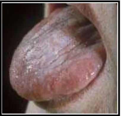 Gambar 9. Coated tongue pada perokok 27 