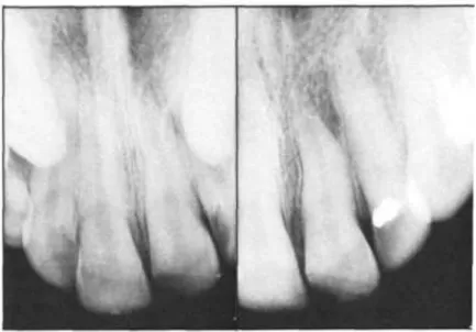 Gambar  4.  Gambaran  gigi  incisivus  sentral  yang  dilakukan  perawatan  pulpa  kaping  :  (kiri)  gambaran    radiograf  sebelum  perawatan  kaping pulpa, (kanan) 52 bulan  setelah  perawatan  pulpa kaping