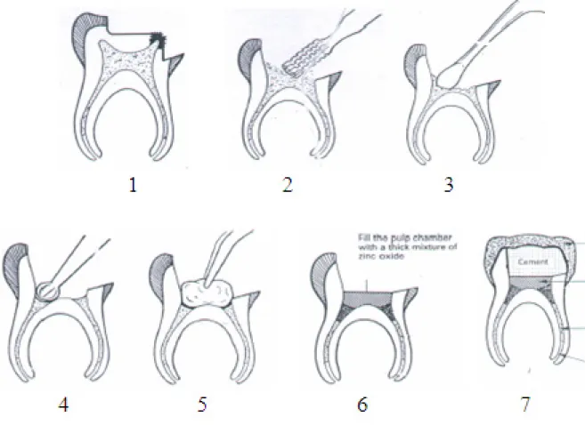 Gambar B. Langkah-langkah Perawatan Pulpotomi Vital Formokresol Satu Kali Kunjungan.1