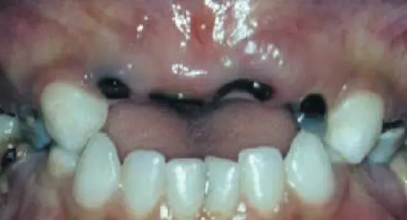 Gambar 1. Lesi pada dentin berwarna kekuningan pada gigidesidui anak.22