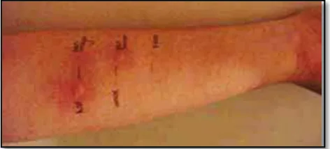 Gambar 1. Tes kulit yang dilakukan pada pasien sebelum diberikan antibiotik.1 