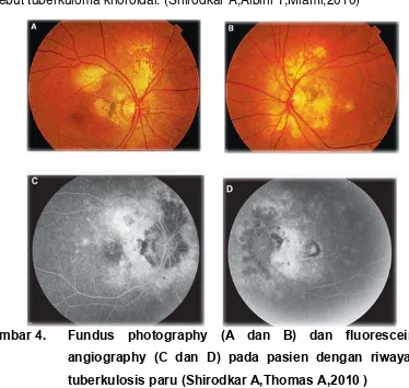 Gambar 4. Fundus photography (A dan B) dan fluorescein 
