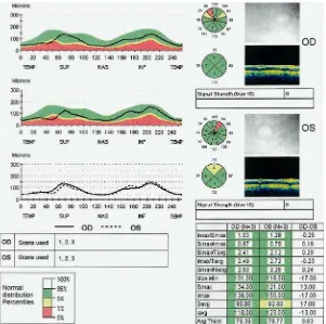 Gambar 4. Hasil Cetakan Fast Retinal Nerve Fiber Layer (RNFL) dengan Meggunakan Stratus OCT 