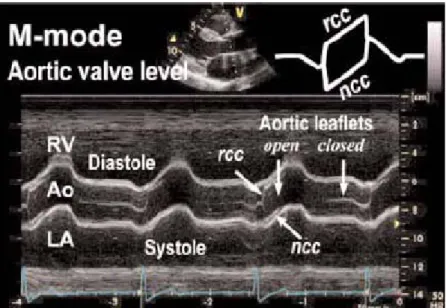 Gambar 2.2. Gambaran M-Mode Katup Aorta (Solomon dkk, 2007)  Sesuai dengan waktu ejeksi ventrikel, daun katup aorta terbuka