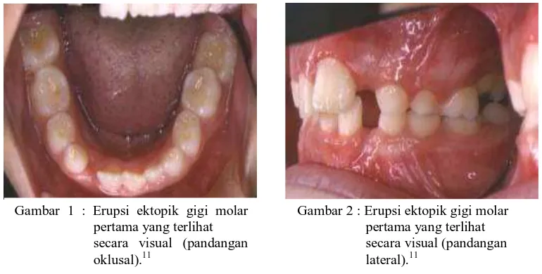 Gambar 1 : Erupsi ektopik gigi molar           pertama yang terlihat  