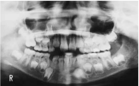 Gambar 3 :  Resorpsi pada permukaan distal akar gigi molar          dua  desidui akibat gigi molar pertama permanen             kanan maksila erupsi ektopik.10   